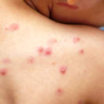 MoH managing probable chickenpox cases among healthcare workers at Sangre Grande Hospital Campus