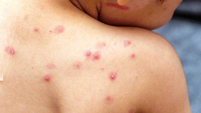 Chickenpox